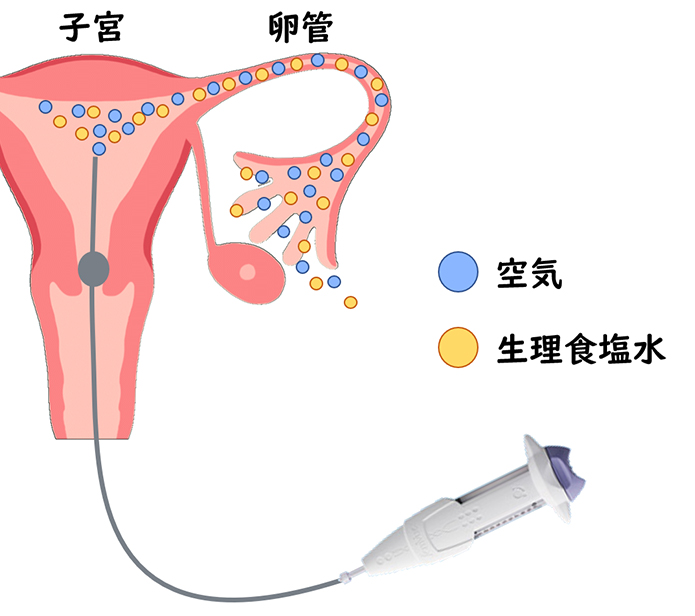超音波下子宮卵管造影検査（フェムビュー）