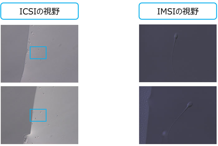 形態学的精子選択術（IMSI）